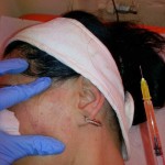 Terapia PRP (Platelet Rich Plasma)