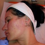 Terapia PRP (Platelet Rich Plasma)