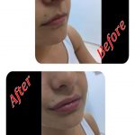 Augmentare buze cu AH#juvederm