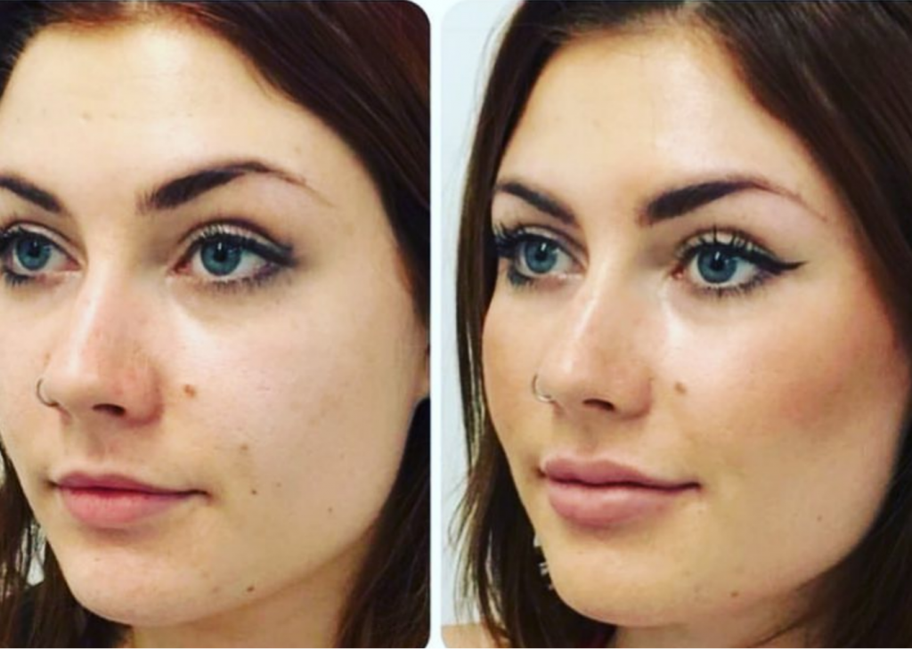 Tratamentul ridurilor cu Toxina Botulinica si Acid Hialuronic