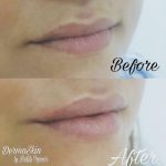 Augmentarea buzelor cu 1ml AH#juvederm - 2
