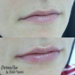 Augmentarea buzelor cu 1ml Juvederm