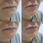 Refacerea etajului inf al fetei cu AH, linii de marioneta, buze si barbie