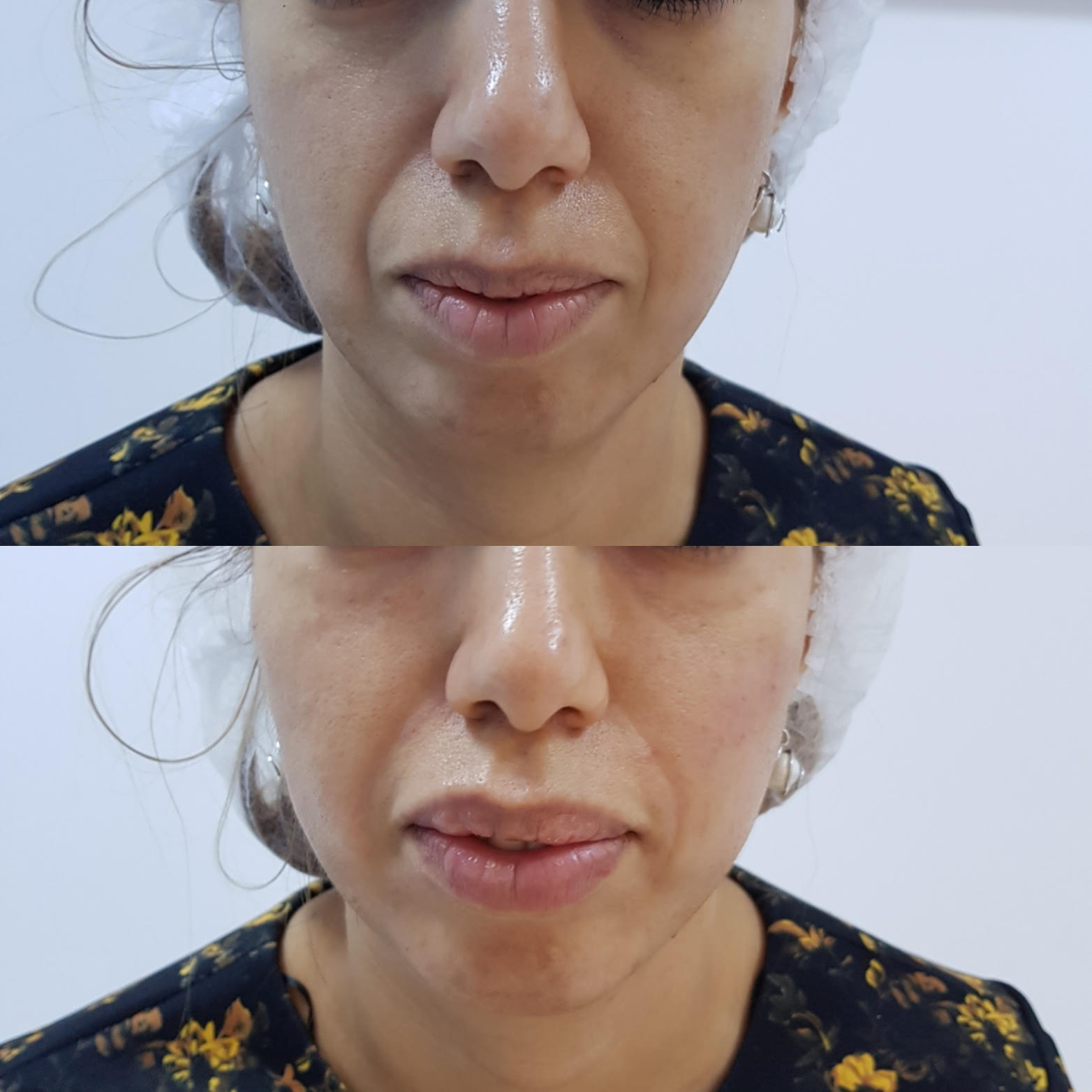 Remodelarea pomeților cu acid hialuronic | SKINOVATE