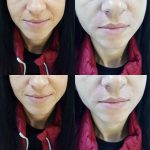 Umplerea santurilor nazogeniene cu AH#juvederm