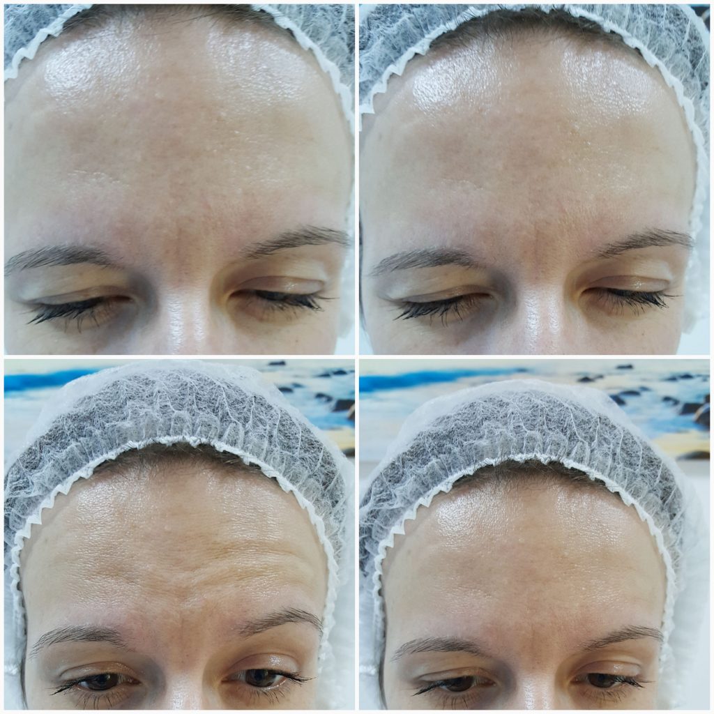 Tratamentul ridurilor cu Toxina Botulinica si Acid Hialuronic