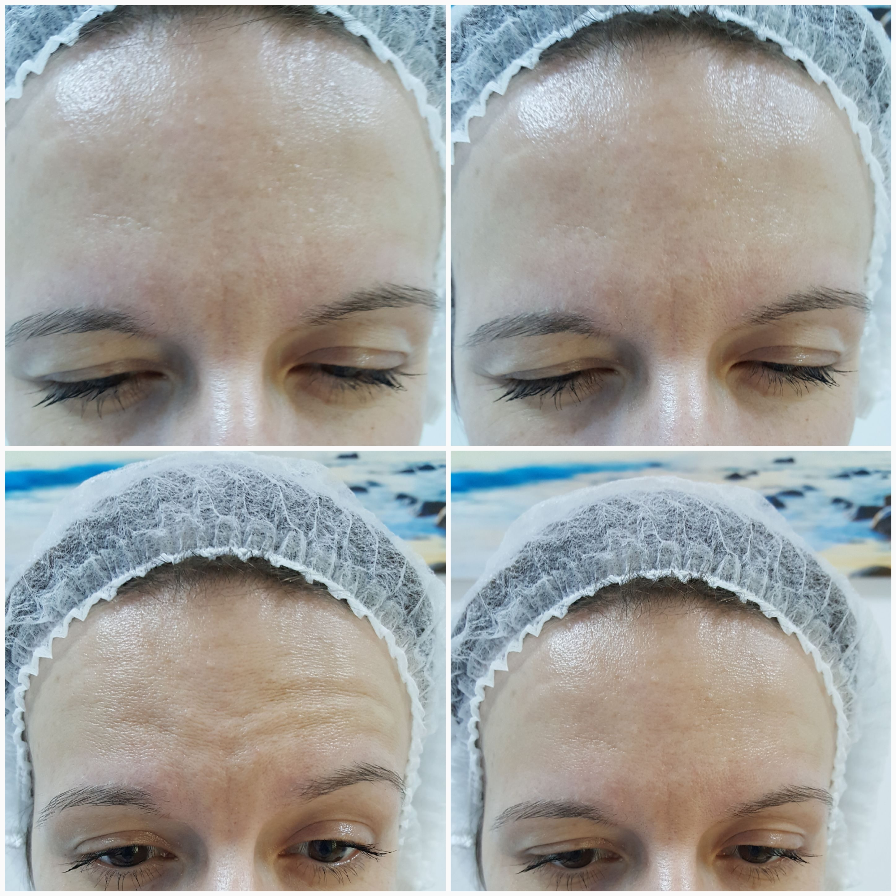 botox in frunte pareri