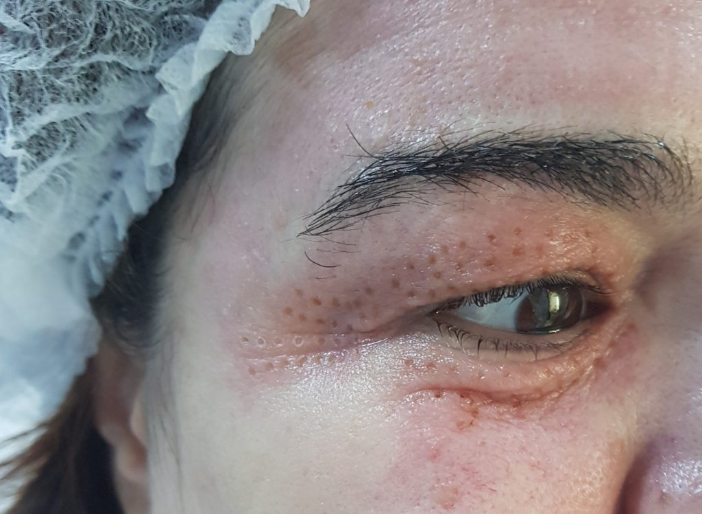 Ptoza pleoapei superioare după tratamentul cu botox picături de ochi