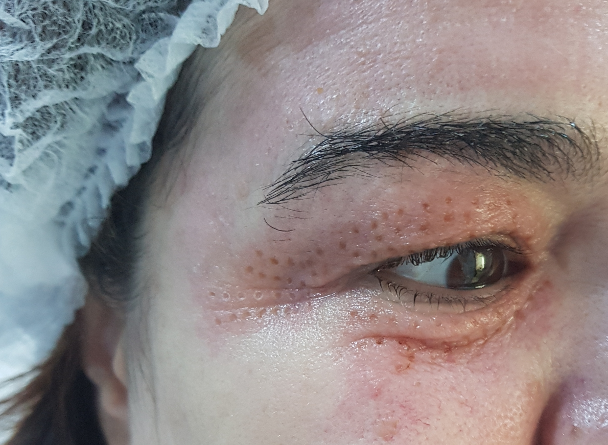 Operația de blefaroplastie - Excizarea pielii lăsate din jurul ochiilor