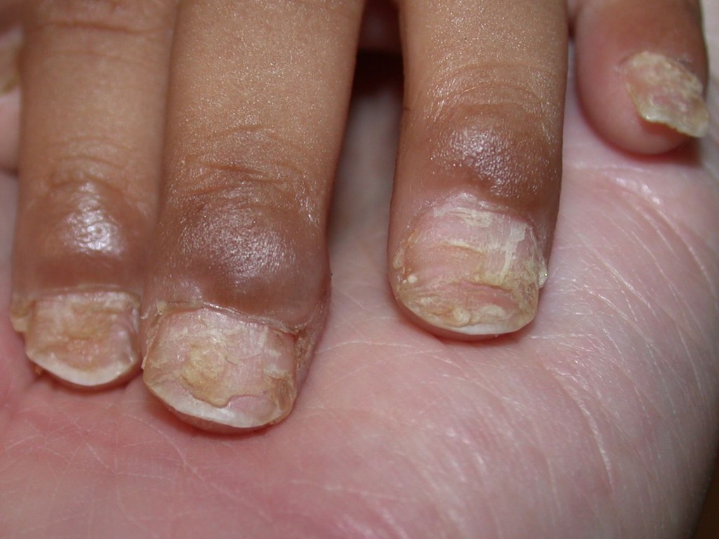 ciuperca unghiilor poate provoca inflamație)