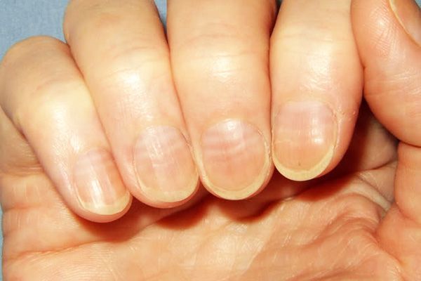 tratamentul ciupercii unghiilor cu kerosen