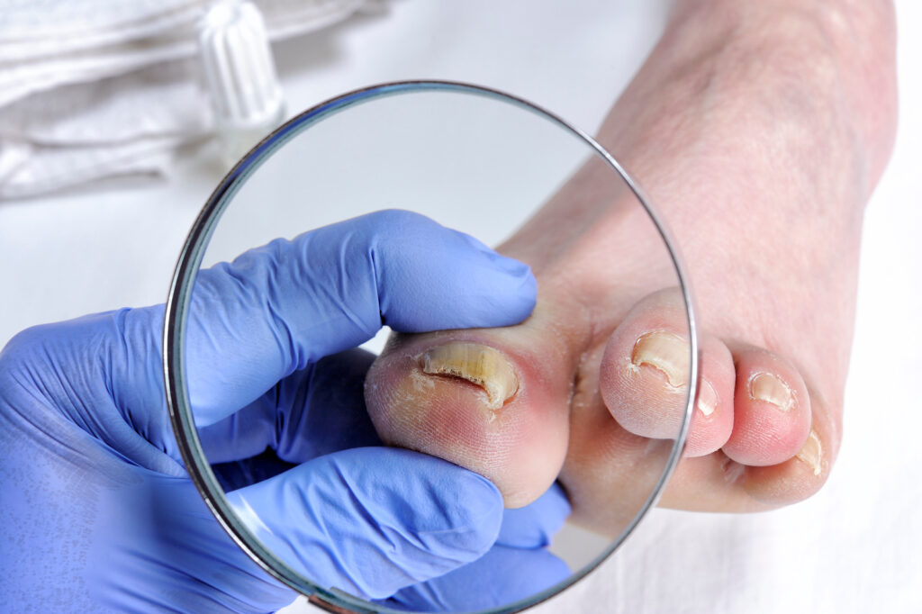 Care medic tratează ciuperca unghiilor de la picioare și unde să meargă? - Picior strâmb - 