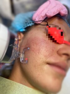 Laser Fracțional CO2