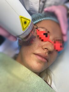 Laser Fracțional CO2