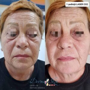 Laser Fracțional CO2