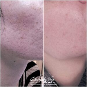 Laser Fracțional CO2