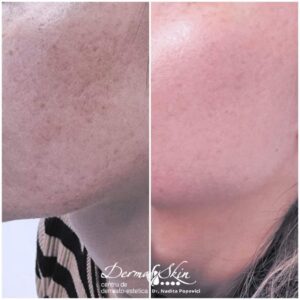 Laser Fracțional CO2