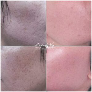 Laser Fracțional CO2