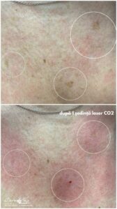Laser Fracțional CO2