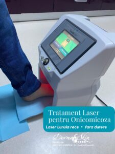 Laser LUNULA pentru Onicomicoza